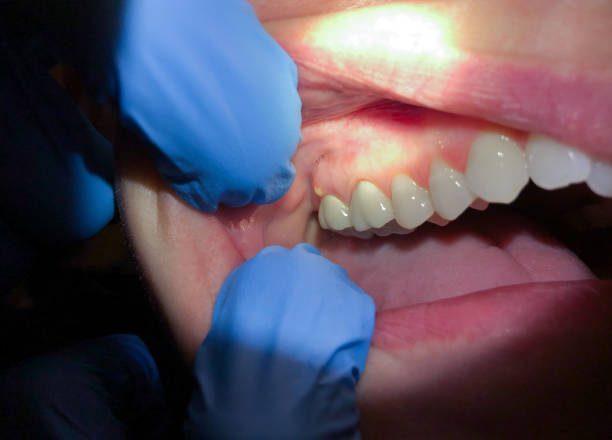 Best Emergency Treatment for Oral Infections in Fort Recovery, OH