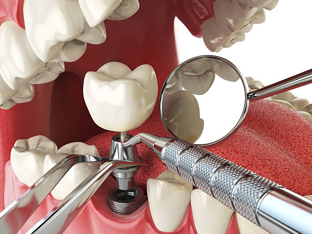 Best Emergency Dental Care for Sports Injuries in Fort Recovery, OH