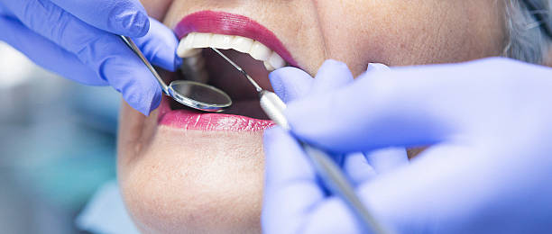 Best Knocked-Out Tooth (Avulsed Tooth) Treatment in Fort Recovery, OH